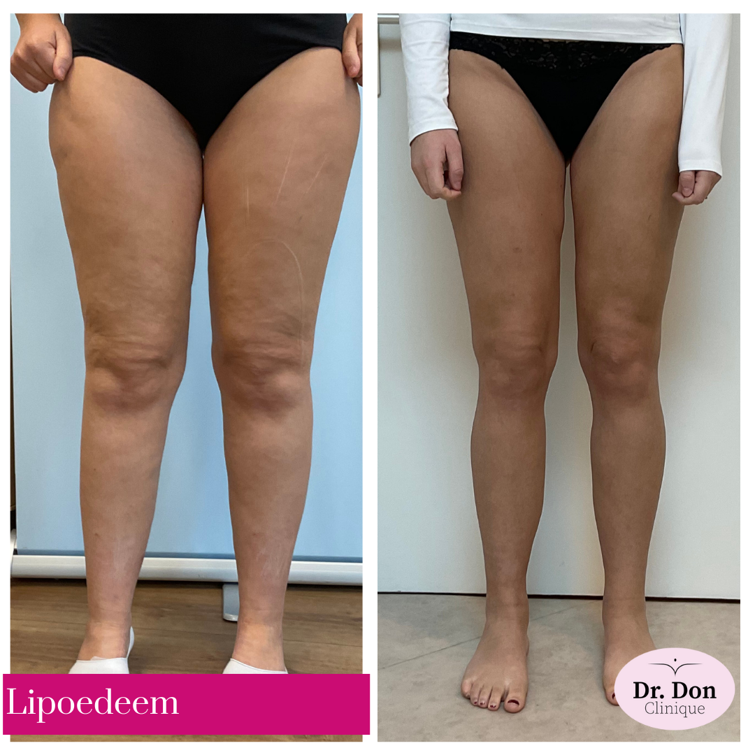 lipoedeem benen clinique dr. don lipoedeem benen clinique dr. don